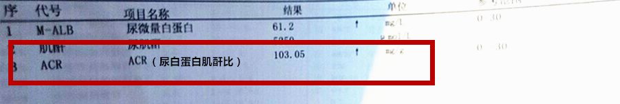 临床目前最常用尿蛋白肌酐比来反应尿微量白蛋白的水平